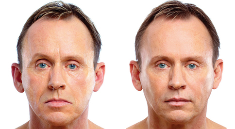 2 minute facelift cream - before-and-after-10